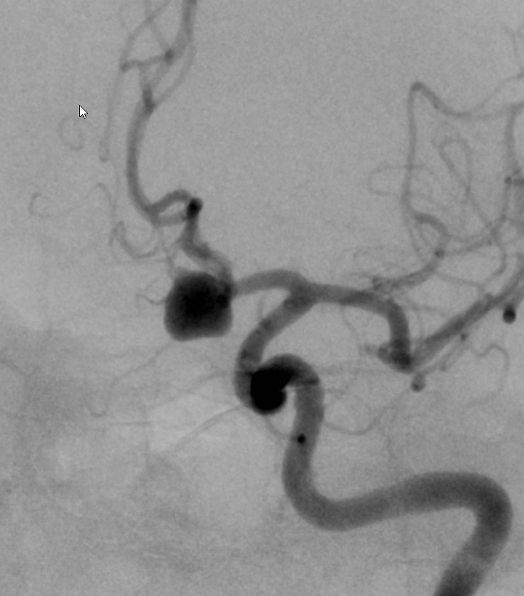 embolizacja-tetniak-mozgu-poznan-02
